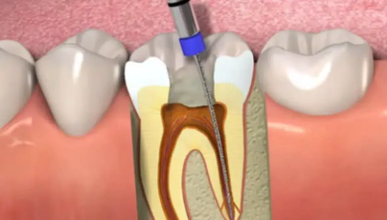 Uzm. Dr. Osman Çetin Cevaplıyor... Her Dişe Kanal Tedavisi Yapılır mı?