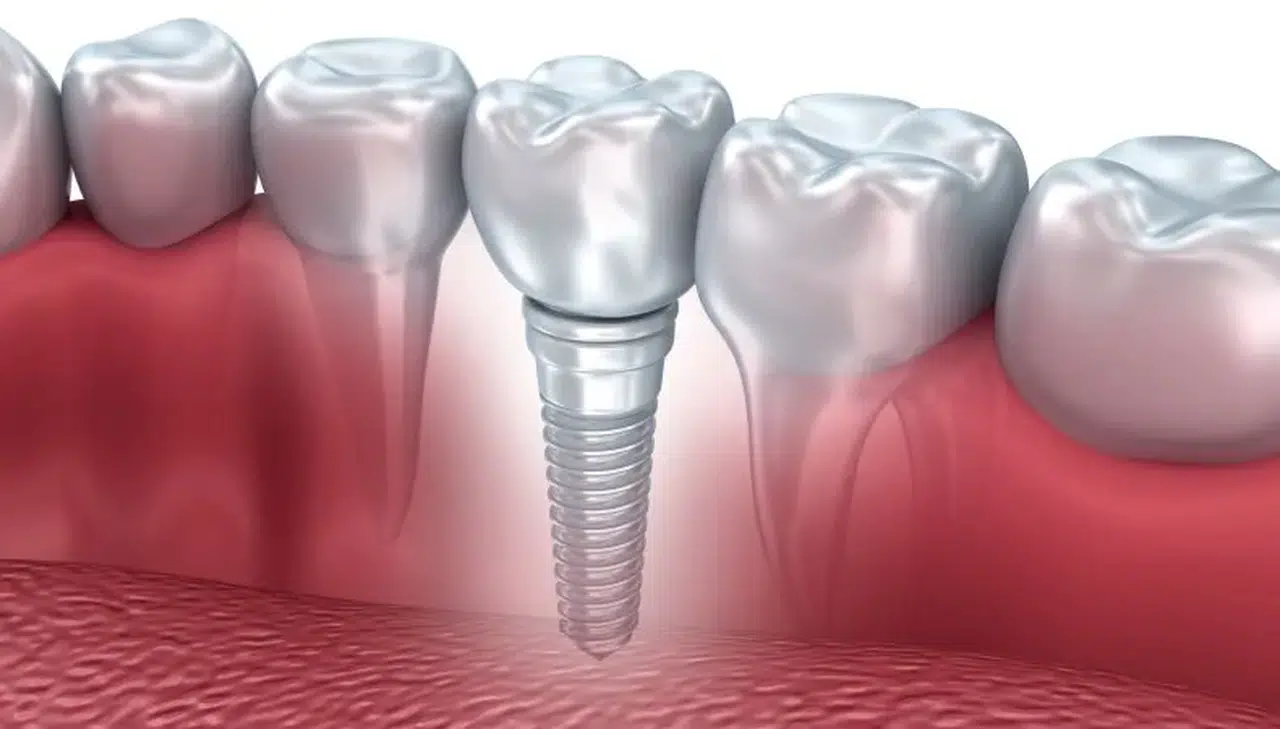İmplant Yaptıranlar Nelere Dikkat Etmeli?