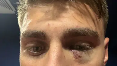 Kazımcan Karataş’a ne oldu? Galatasaray - Fenerbahçe derbisinde yaşanan olayın detayları