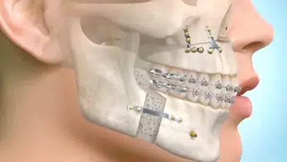 Çene Ekleminde Kayma Nedir? Uzman Doktor Osman Uyarıyor: Dikkate Alınmazsa Büyük Sorunlara Yol Açabilir!