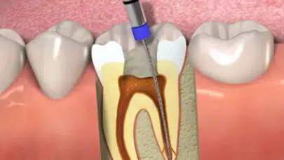 Uzm. Dr. Osman Çetin Cevaplıyor... Her Dişe Kanal Tedavisi Yapılır mı?