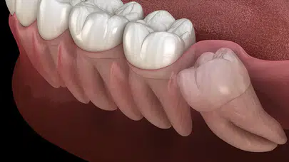 Uzm. Dr. Osman Çetin cevaplıyor!Gömülü 20’lik Diş Çekimi Nasıl Yapılır?