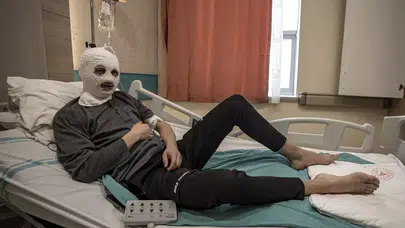 Erzurum’da Çakmak Gazı Patladı: 19 Yaşındaki Genç Yüzü ve Göğsünden Yanarak Hastaneye Kaldırıldı “Ben Yandım, Başkaları Yanmasın”