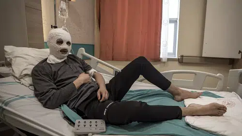 Erzurum’da Çakmak Gazı Patladı: 19 Yaşındaki Genç Yüzü ve Göğsünden Yanarak Hastaneye Kaldırıldı “Ben Yandım, Başkaları Yanmasın”